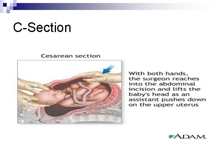 C-Section 
