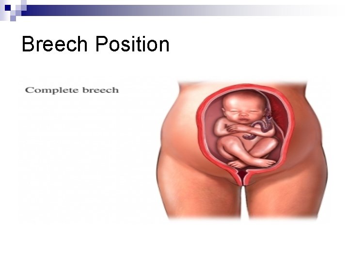 Breech Position 