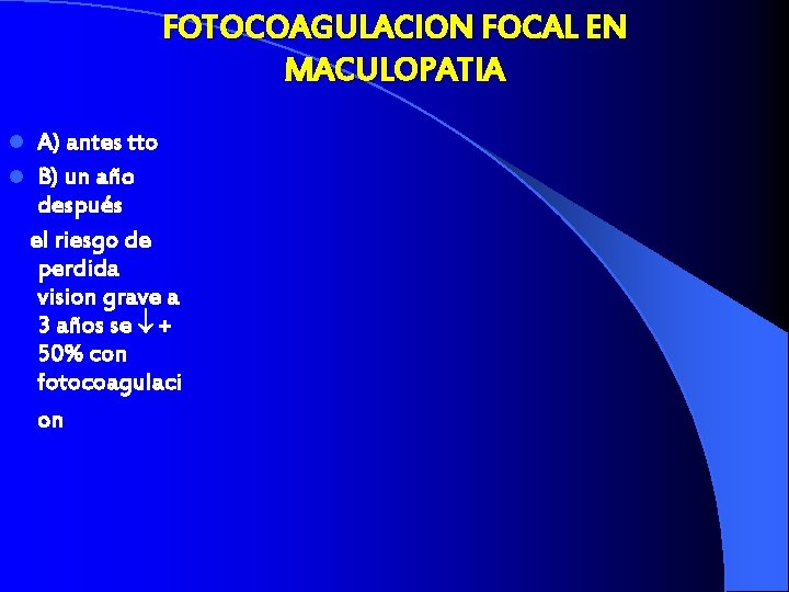FOTOCOAGULACION FOCAL EN MACULOPATIA A) antes tto l B) un año después el riesgo