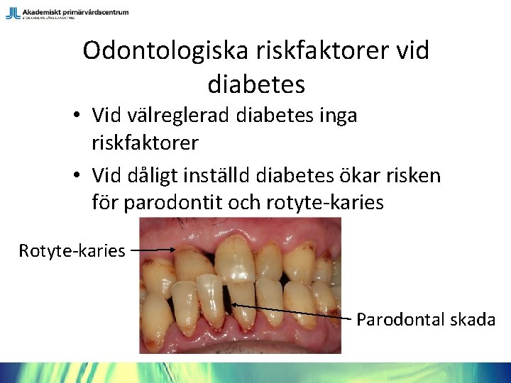 Odontologiska riskfaktorer vid diabetes • Vid välreglerad diabetes inga riskfaktorer • Vid dåligt inställd