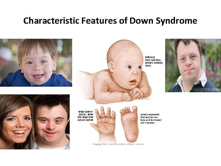 Characteristic Features of Down Syndrome 