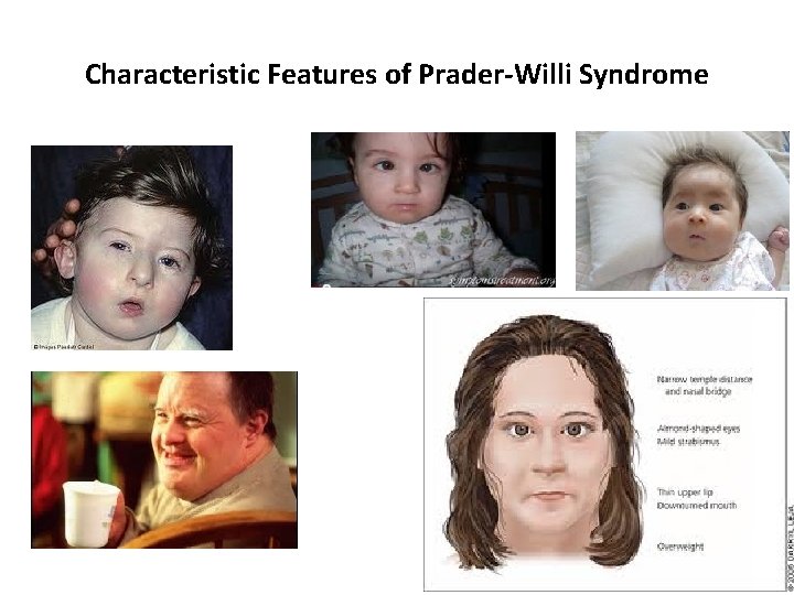 Characteristic Features of Prader-Willi Syndrome 