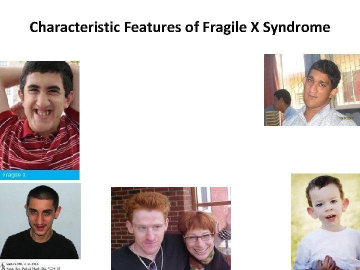 Characteristic Features of Fragile X Syndrome 