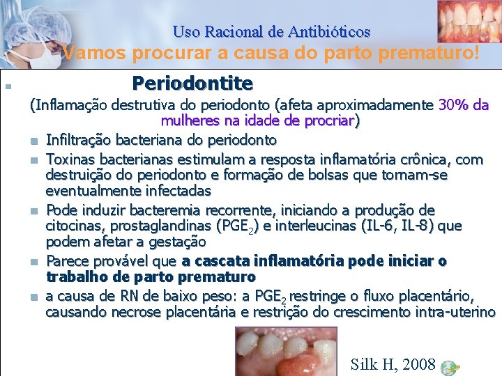 Uso Racional de Antibióticos Vamos procurar a causa do parto prematuro! n Periodontite (Inflamação