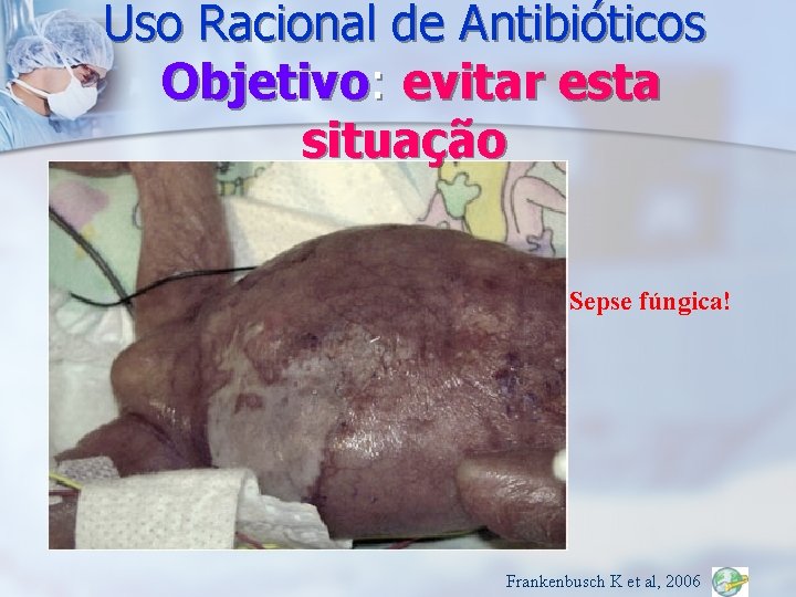 Uso Racional de Antibióticos Objetivo: evitar esta situação Sepse fúngica! Frankenbusch K et al,