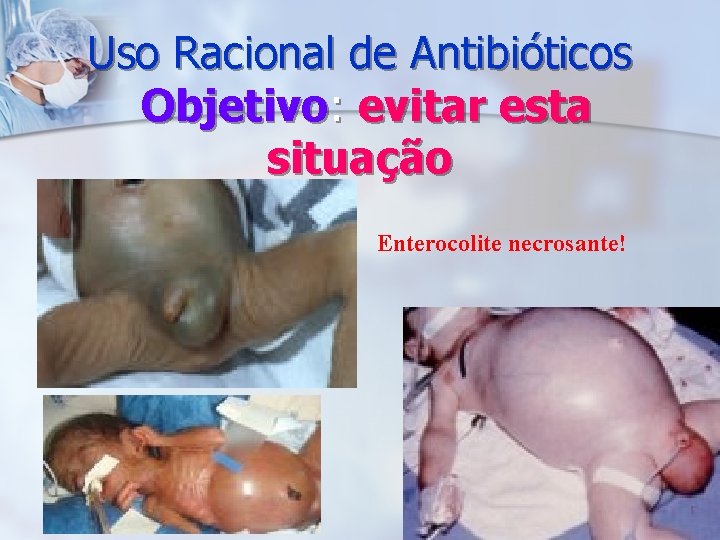 Uso Racional de Antibióticos Objetivo: evitar esta situação Enterocolite necrosante! 