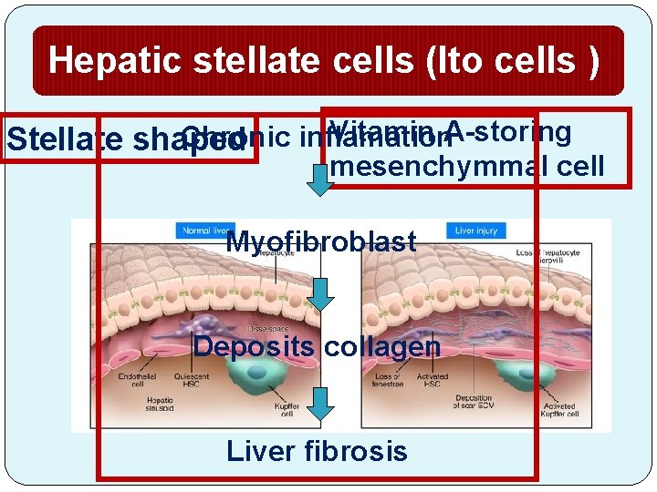 Hepatic stellate cells (Ito cells ) Vitamin A-storing Chronic inflamation Stellate shaped mesenchymmal cell