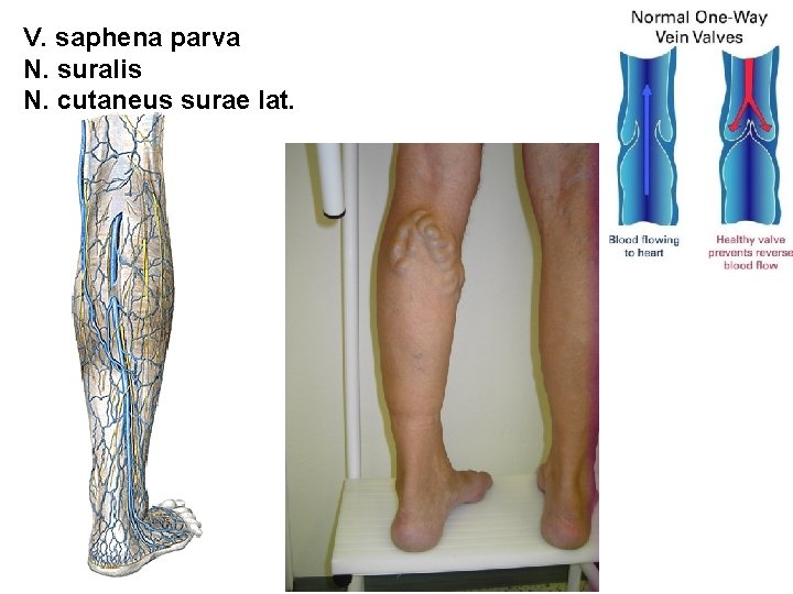 V. saphena parva N. suralis N. cutaneus surae lat. 