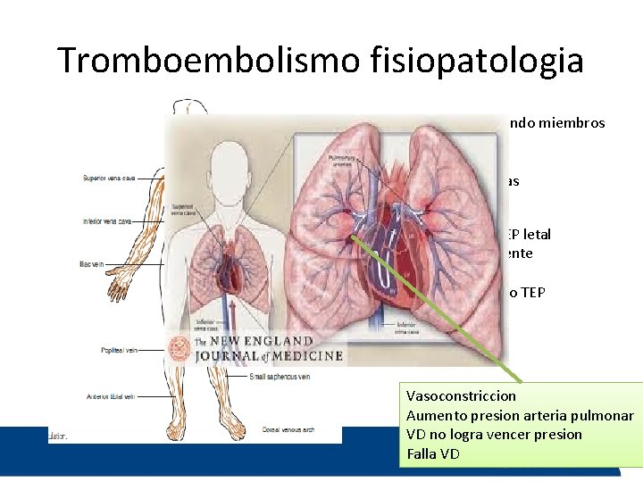 Tromboembolismo fisiopatologia Sistema venoso profundo miembros Inferiores Ventriculo derecho Venas renales, pelvicas TVP proximal: