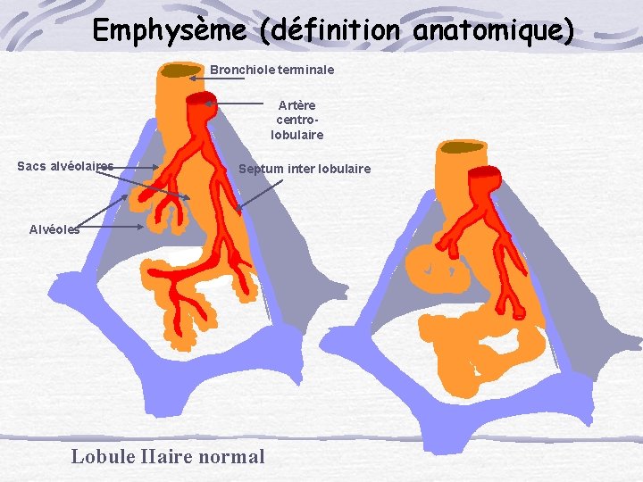Emphysème (définition anatomique) Bronchiole terminale Artère centrolobulaire Sacs alvéolaires Septum inter lobulaire Alvéoles Lobule