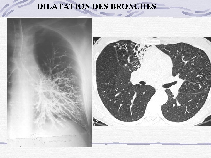 DILATATION DES BRONCHES 