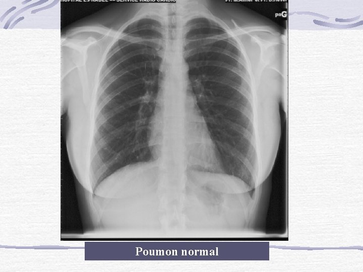 Poumon normal 