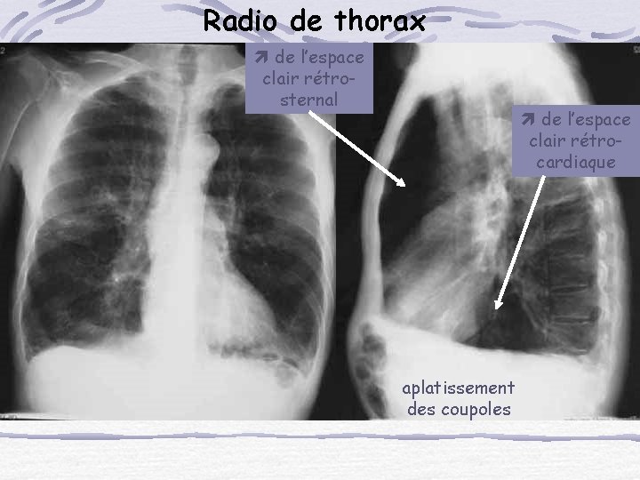 Radio de thorax de l’espace clair rétrosternal de l’espace clair rétrocardiaque aplatissement des coupoles