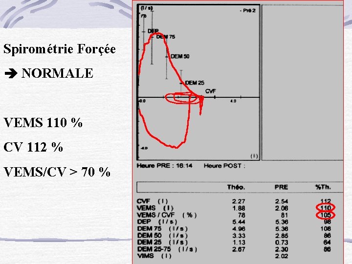 Spirométrie Forçée NORMALE VEMS 110 % CV 112 % VEMS/CV > 70 % 