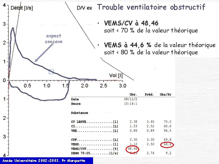 Trouble ventilatoire obstructif aspect concave Année Universitaire 2002 -2003. Pr Marquette • VEMS/CV à