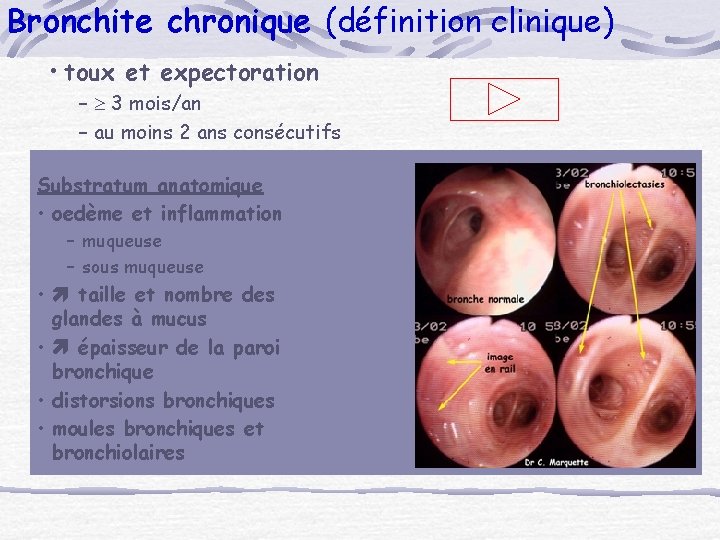 Bronchite chronique (définition clinique) • toux et expectoration – 3 mois/an – au moins