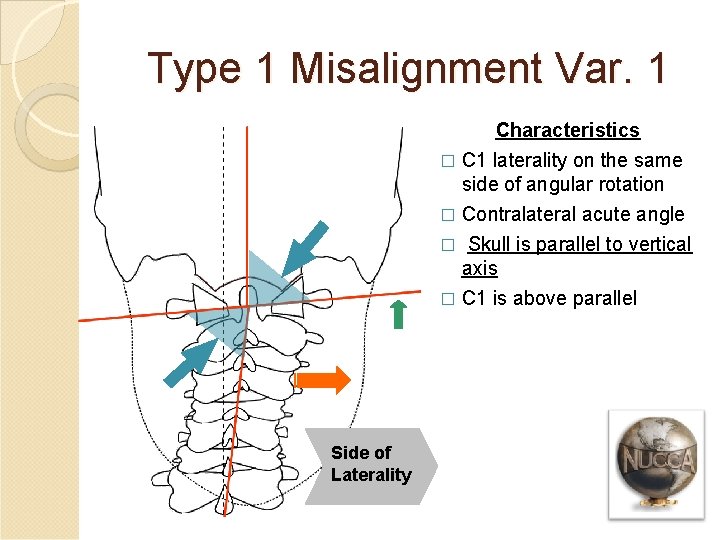Type 1 Misalignment Var. 1 Characteristics � C 1 laterality on the same side