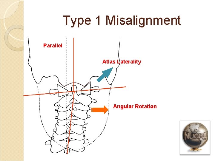 Type 1 Misalignment Parallel Atlas Laterality Angular Rotation 