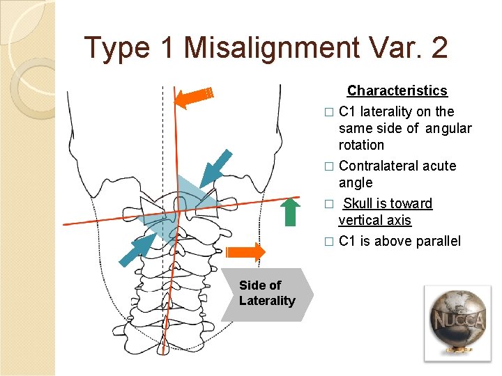Type 1 Misalignment Var. 2 Characteristics � C 1 laterality on the same side
