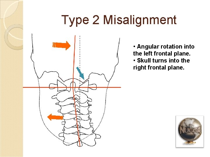 Type 2 Misalignment • Angular rotation into the left frontal plane. • Skull turns