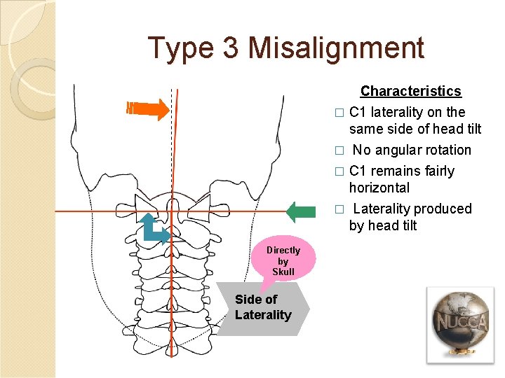 Type 3 Misalignment Characteristics � C 1 laterality on the same side of head
