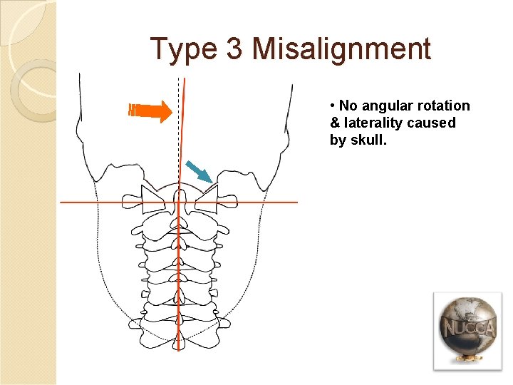Type 3 Misalignment • No angular rotation & laterality caused by skull. 