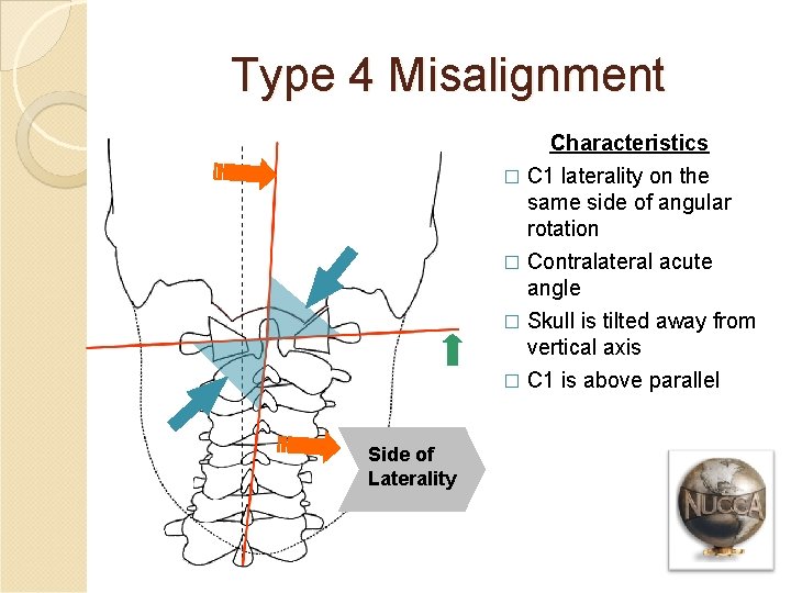 Type 4 Misalignment Characteristics � C 1 laterality on the same side of angular