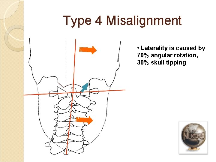 Type 4 Misalignment • Laterality is caused by 70% angular rotation, 30% skull tipping