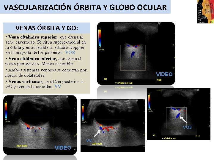 VASCULARIZACIÓN ÓRBITA Y GLOBO OCULAR VENAS ÓRBITA Y GO: • Vena oftálmica superior, que