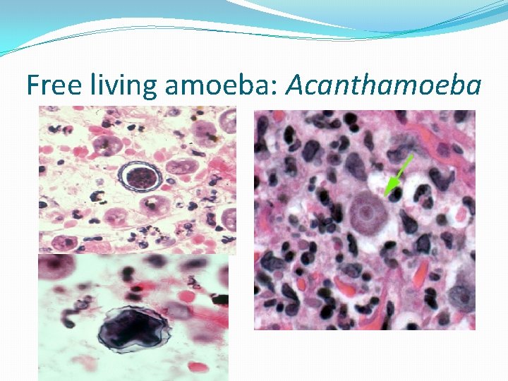 Free living amoeba: Acanthamoeba 