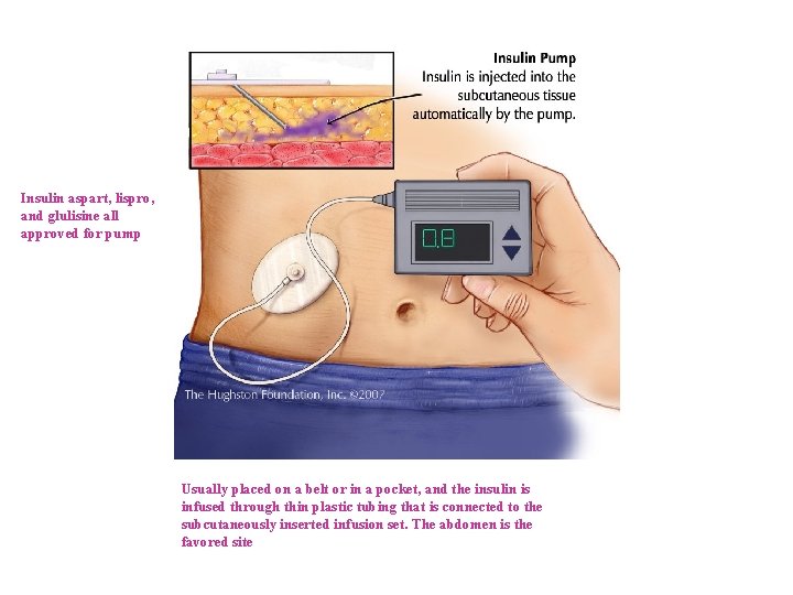 Insulin aspart, lispro, and glulisine all approved for pump Usually placed on a belt