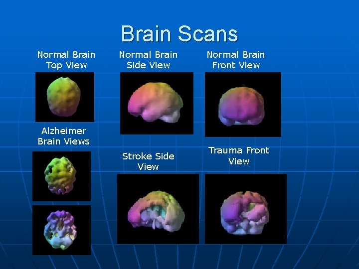 Brain Scans Normal Brain Top View Normal Brain Side View Alzheimer Brain Views Stroke