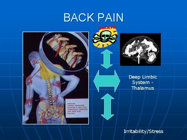BACK PAIN Deep Limbic System Thalamus Irritability/Stress 