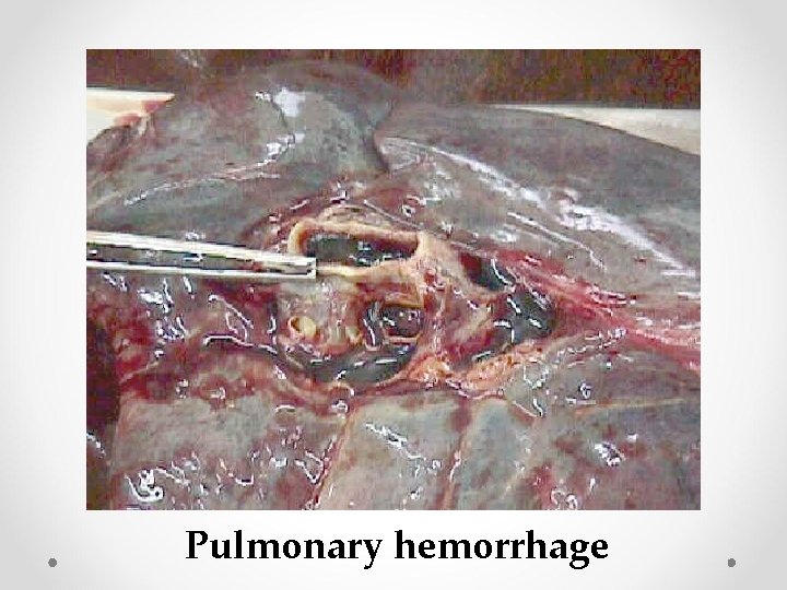 Pulmonary hemorrhage 