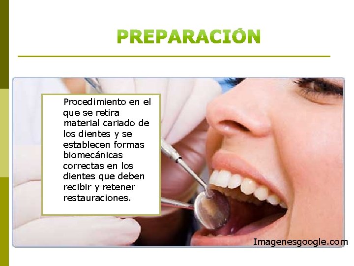 Procedimiento en el que se retira material cariado de los dientes y se establecen
