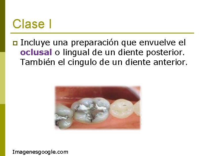 Clase I p Incluye una preparación que envuelve el oclusal o lingual de un