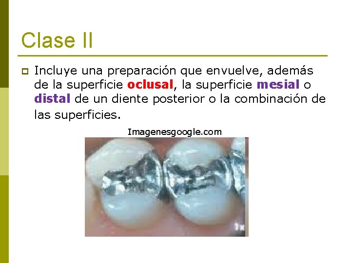 Clase II p Incluye una preparación que envuelve, además de la superficie oclusal, la