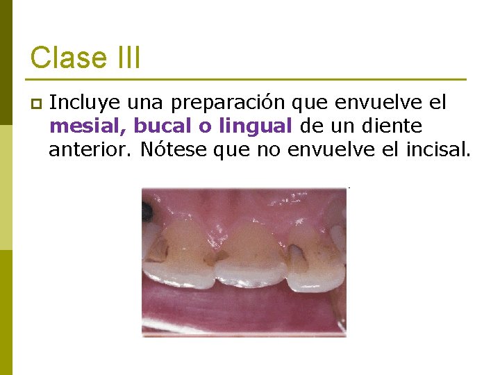 Clase III p Incluye una preparación que envuelve el mesial, bucal o lingual de