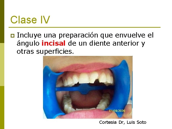 Clase IV p Incluye una preparación que envuelve el ángulo incisal de un diente