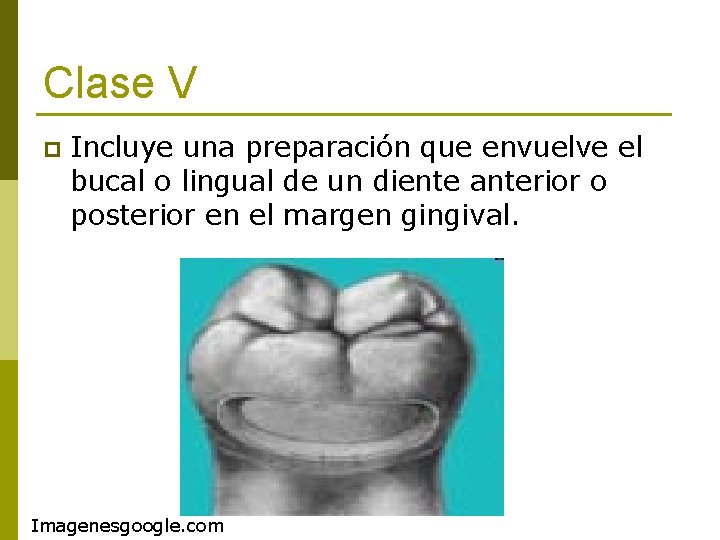 Clase V p Incluye una preparación que envuelve el bucal o lingual de un