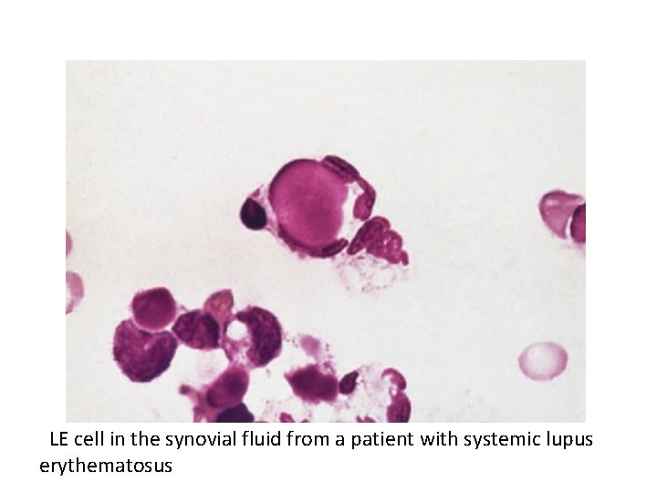 LE cell in the synovial fluid from a patient with systemic lupus erythematosus 