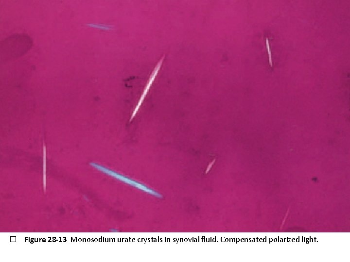 � Figure 28 -13 Monosodium urate crystals in synovial fluid. Compensated polarized light. 