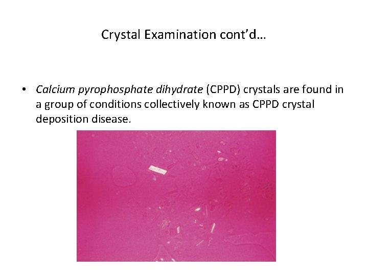 Crystal Examination cont’d… • Calcium pyrophosphate dihydrate (CPPD) crystals are found in a group