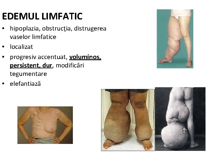 EDEMUL LIMFATIC • hipoplazia, obstrucţia, distrugerea vaselor limfatice • localizat • progresiv accentuat, voluminos,