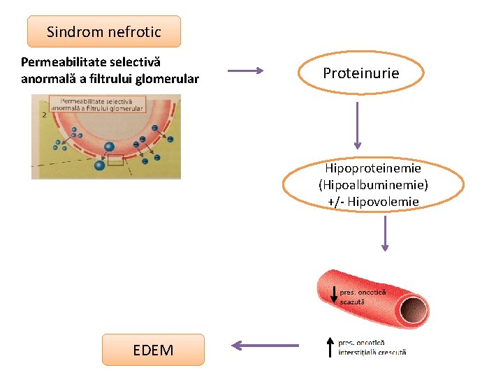 Sindrom nefrotic Permeabilitate selectivă anormală a filtrului glomerular Proteinurie Hipoproteinemie (Hipoalbuminemie) +/- Hipovolemie EDEM