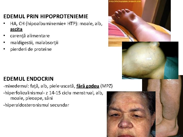 EDEMUL PRIN HIPOPROTENIEMIE • HA, CH (hipoalbuminemie+ HTP): moale, alb, ascita • carenţă alimentare