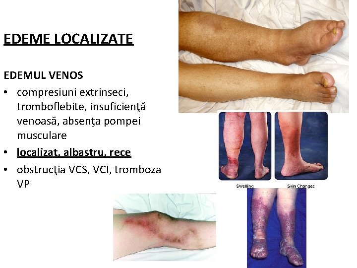 EDEME LOCALIZATE EDEMUL VENOS • compresiuni extrinseci, tromboflebite, insuficienţă venoasă, absenţa pompei musculare •