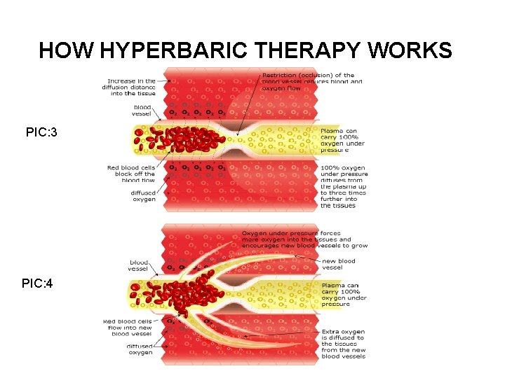 HOW HYPERBARIC THERAPY WORKS PIC: 3 PIC: 4 