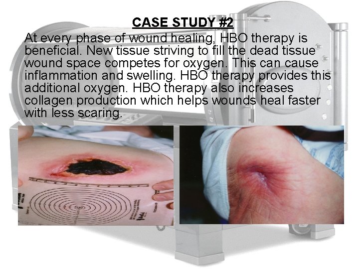 CASE STUDY #2 At every phase of wound healing, HBO therapy is beneficial. New