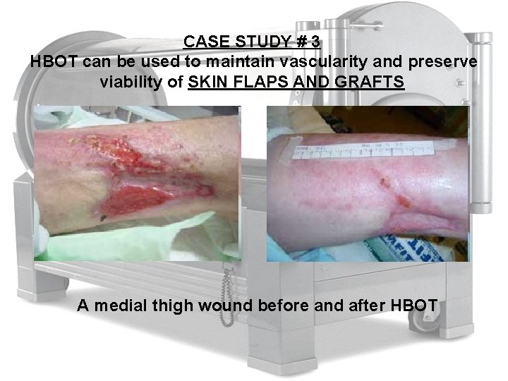 CASE STUDY # 3 HBOT can be used to maintain vascularity and preserve viability